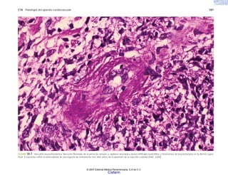 C18 Patología del aparato cardiovascular 587
FIGURA 18-7. Vasculitis leucocitoclástica. Necrosis fibrinoide de la pared de vénulas y capilares asociada a denso infiltrado neutrofílico y fenómenos de leucocitoclasia en la dermis super-
ficial. El paciente refirió el antecedente de una ingesta de eritromicina tres días antes de la aparición de la reacción cutánea (H&E, x400).
© 2007 Editorial Médica Panamericana, S.A de C.V.
Cisfarm
 