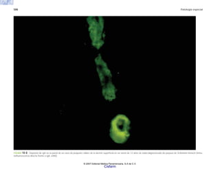 588 Patología especial
FIGURA 18-8. Depósito de IgA en la pared de un vaso de pequeño calibre de la dermis superficial en un varón de 12 años de edad diagnosticado de púrpura de Schönlein-Henoch (inmu-
nofluorescencia directa frente a IgA, x400).
© 2007 Editorial Médica Panamericana, S.A de C.V.
Cisfarm
 