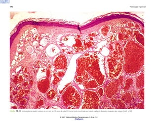 590 Patología especial
FIGURA 18-10. Hemangioma capilar cutáneo en un niño de 10 años de edad. El tumor está constituido por vasos capilares dilatados ocupados por sangre (H&E, x100).
© 2007 Editorial Médica Panamericana, S.A de C.V.
Cisfarm
 