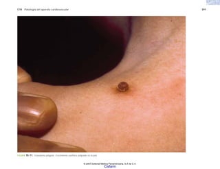 C18 Patología del aparato cardiovascular 591
FIGURA 18-11. Granuloma piógeno. Crecimiento exofítico polipoide en la piel.
© 2007 Editorial Médica Panamericana, S.A de C.V.
Cisfarm
 