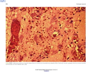 592 Patología especial
FIGURA 18-12. Angiomatosis bacilar en un paciente diagnosticado con síndrome de inmunodeficiencia adquirida (SIDA). Proliferación vascular y agregados densos de material eosinófilo
entremezclados con vasos dilatados (H&E, x200).
© 2007 Editorial Médica Panamericana, S.A de C.V.
Cisfarm
 