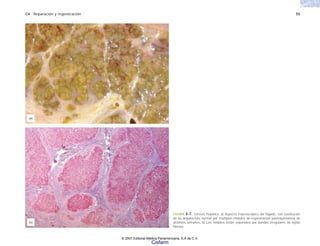 C4 Reparación y regeneración 55
FIGURA 4-7. Cirrosis hepática. a) Aspecto macroscópico del hígado, con sustitución
de su arquitectura normal por múltiples nódulos de regeneración parenquimatosa de
distintos tamaños. b) Los nódulos están separados por bandas irregulares de tejido
fibroso.
(a)
(b)
© 2007 Editorial Médica Panamericana, S.A de C.V.
Cisfarm
 