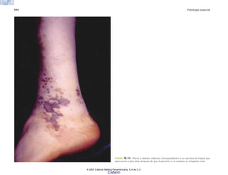 594 Patología especial
FIGURA 18-14. Placas y nódulos violáceos correspondientes a un sarcoma de Kaposi que
aparecieron cuatro años después de que al paciente se le realizara un trasplante renal.
© 2007 Editorial Médica Panamericana, S.A de C.V.
Cisfarm
 