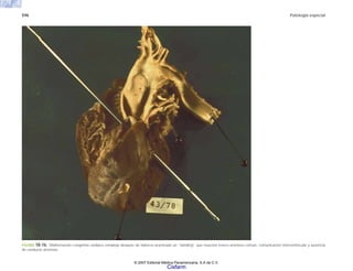 596 Patología especial
FIGURA 18-16. Malformación congénita cardiaca compleja después de haberse practicado un “banding” que muestra tronco arterioso común, comunicación interventricular y ausencia
de conducto arterioso.
© 2007 Editorial Médica Panamericana, S.A de C.V.
Cisfarm
 