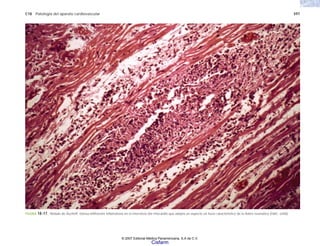 C18 Patología del aparato cardiovascular 597
FIGURA 18-17. Nódulo de Aschoff. Densa infiltración inflamatoria en el intersticio del miocardio que adopta un aspecto en huso característico de la fiebre reumática (H&E, x200).
© 2007 Editorial Médica Panamericana, S.A de C.V.
Cisfarm
 
