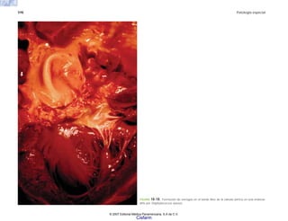 598 Patología especial
FIGURA 18-18. Formación de verrugas en el borde libre de la válvula aórtica en una endocar-
ditis por Staphylococcus aureus.
© 2007 Editorial Médica Panamericana, S.A de C.V.
Cisfarm
 