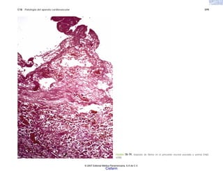 C18 Patología del aparato cardiovascular 599
FIGURA 18-19. Depósito de fibrina en el pericardio visceral asociado a uremia (H&E,
x200).
© 2007 Editorial Médica Panamericana, S.A de C.V.
Cisfarm
 