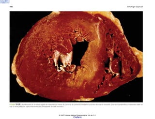 600 Patología especial
FIGURA 18-20. Identificación de un infarto agudo de miocardio de menos de 24 horas de evolución mediante la técnica del azul de tetrazolio. Esta técnica identifica el miocardio viable en
rojo. El área pálida del septo interventricular corresponde al tejido necrótico.
© 2007 Editorial Médica Panamericana, S.A de C.V.
Cisfarm
 