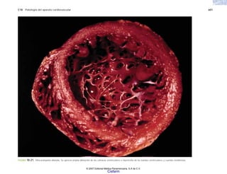 C18 Patología del aparato cardiovascular 601
FIGURA 18-21. Miocardiopatía dilatada. Se aprecia amplia dilatación de las cámaras ventriculares e hipertrofia de las bandas ventriculares y cuerdas tendinosas.
© 2007 Editorial Médica Panamericana, S.A de C.V.
Cisfarm
 