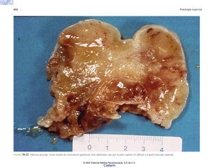 602 Patología especial
FIGURA 18-22. Mixoma auricular. Tumor blando de consistencia gelatinosa, bien delimitado, que por la parte superior se adhería a la pared auricular izquierda.
© 2007 Editorial Médica Panamericana, S.A de C.V.
Cisfarm
 