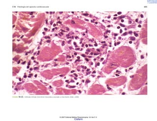 C18 Patología del aparato cardiovascular 603
FIGURA 18-23. Infiltrado linfoide intersticial miocárdico asociado a miocitolisis (H&E, x400).
© 2007 Editorial Médica Panamericana, S.A de C.V.
Cisfarm
 