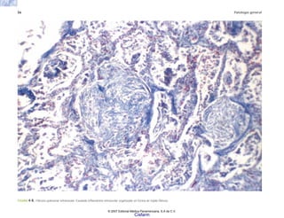 56 Patología general
FIGURA 4-8. Fibrosis pulmonar intralveolar. Exudado inflamatorio intraveolar organizado en forma de tejido fibroso.
© 2007 Editorial Médica Panamericana, S.A de C.V.
Cisfarm
 