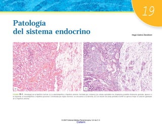 19
Hugo Galera Davidson
Patología
del sistema endocrino
Patología
del sistema endocrino
FIGURA 19-1. Histología de la hipófisis normal. a) La adenohipófisis o hipófisis anterior, formada por cordones de células epiteliales de citoplasma acidófilo finamente granular, aparece a
la izquierda; la neurohipófisis o hipófisis posterior, constituida por tejido nervioso, se encuentra a la derecha. b) Con tinción de ácido periódico-Schiff se aprecia mejor el carácter glandular
de la hipófisis anterior.
(a) (b)
© 2007 Editorial Médica Panamericana, S.A de C.V.
Cisfarm
 