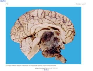 612 Patología especial
FIGURA 19-2. Adenoma hipofisiario de gran tamaño, con compresión de estructuras vecinas, necrosis y hemorragia.
© 2007 Editorial Médica Panamericana, S.A de C.V.
Cisfarm
 