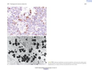 C19 Patología del sistema endocrino 613
FIGURA 19-3. Adenoma hipofisiario secretor de prolactina. a) Presencia de células positi-
vas para prolactina, demostrada por inmunohistoquímica. b) Ultraestructura de los gránulos
citoplásmaticos en células secretoras de prolactina del mismo tumor.
(b)
(a)
© 2007 Editorial Médica Panamericana, S.A de C.V.
Cisfarm
 