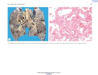 C4 Reparación y regeneración 57
FIGURA 4-9. Fibrosis pulmonar intersticial difusa. a) Pulmones hiperextensos con lesiones microquísticas múltiples. b) Engrosamiento generalizado de los tabiques alveolares.
(a) (b)
© 2007 Editorial Médica Panamericana, S.A de C.V.
Cisfarm
 