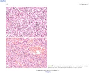 614 Patología especial
FIGURA 19-4. Histología de los adenomas hipofisiarios. a) Patrón uniforme de células
pequeñas. b) Patrón trabecular o papilar, con espacios de aspecto glandular.
(b)
(a)
© 2007 Editorial Médica Panamericana, S.A de C.V.
Cisfarm
 
