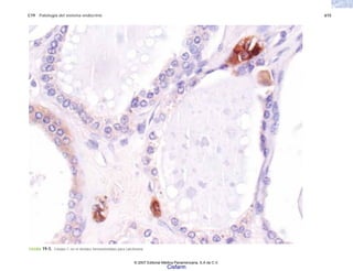 C19 Patología del sistema endocrino 615
FIGURA 19-5. Células C en el tiroides inmunoteñidas para calcitonina.
© 2007 Editorial Médica Panamericana, S.A de C.V.
Cisfarm
 