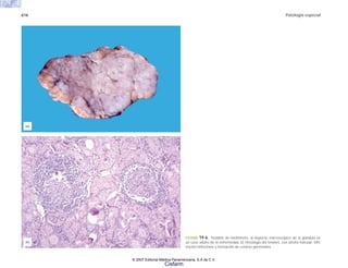 616 Patología especial
(a)
(b)
FIGURA 19-6. Tiroiditis de Hashimoto. a) Aspecto macroscópico de la glándula en
un caso adulto de la enfermedad. b) Histología del tiroides, con atrofia folicular, infil-
tración linfocitaria y formación de centros germinales.
© 2007 Editorial Médica Panamericana, S.A de C.V.
Cisfarm
 