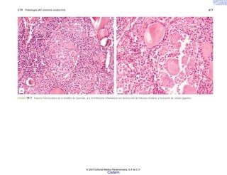 C19 Patología del sistema endocrino 617
FIGURA 19-7. Aspecto microscópico de la tiroiditis de Quervain. a) y b) Infiltración inflamatoria con destrucción de folículos tiroideos y formación de células gigantes.
(b)
(a)
© 2007 Editorial Médica Panamericana, S.A de C.V.
Cisfarm
 