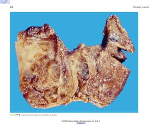 618 Patología especial
FIGURA 19-8. Aspecto macroscópico de la tiroiditis de Riedel.
© 2007 Editorial Médica Panamericana, S.A de C.V.
Cisfarm
 
