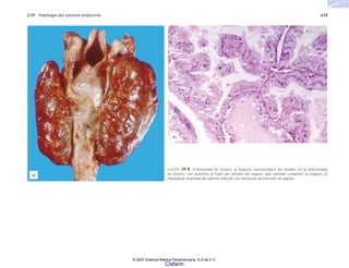 C19 Patología del sistema endocrino 619
(a)
(b)
FIGURA 19-9. Enfermedad de Graves. a) Aspecto macroscópico del tiroides en la enfermedad
de Graves, con aumento al triple del tamaño del órgano, que además comprime la tráquea. b)
Hiperplasia avanzada del epitelio folicular con formación prominente de papilas.
© 2007 Editorial Médica Panamericana, S.A de C.V.
Cisfarm
 