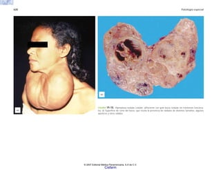 620 Patología especial
(b)
(a)
FIGURA 19-10. Hiperplasia nodular coloide. a)Paciente con gran bocio nodular sin trastornos funciona-
les. b) Superficie de corte del bocio, que revela la presencia de nódulos de distintos tamaños, algunos
quísticos y otros sólidos.
© 2007 Editorial Médica Panamericana, S.A de C.V.
Cisfarm
 