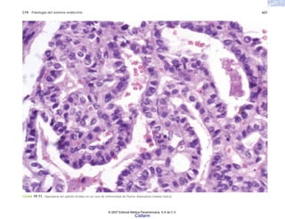 C19 Patología del sistema endocrino 621
FIGURA 19-11. Hiperplasia del epitelio tiroideo en un caso de enfermedad de Plumer (hiperplasia nodular tóxica).
© 2007 Editorial Médica Panamericana, S.A de C.V.
Cisfarm
 