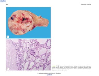 622 Patología especial
FIGURA 19-12. Adenoma folicular del tiroides. a) Superficie de corte de un adenoma
folicular de gran tamaño, con necrosis y calcificación.b) Folículos de diferentes tama-
ños con espacios interfoliculares irregulares; se observa parte de la cápsula que separa
al adenoma del resto del tiroides.
(b)
(a)
© 2007 Editorial Médica Panamericana, S.A de C.V.
Cisfarm
 