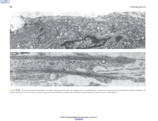 58 Patología general
FIGURA 4-10. Ultraestructura del miofibroblasto. En la parte inferior aparece parte del citoplasma de un miofibroblasto. La presencia de fascículos de microfibrillas paralelas asociadas con
cuerpos densos es clara. En la parte superior hay parte de un fibroblasto ortodoxo para comparar su ultraestructura. (Cortesía del Dr. Guido Majno.)
© 2007 Editorial Médica Panamericana, S.A de C.V.
Cisfarm
 