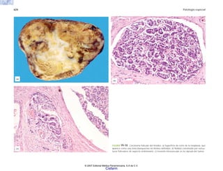 624 Patología especial
FIGURA 19-14. Carcinoma folicular del tiroides. a) Superficie de corte de la neoplasia, que
aparece como una zona blanquecina sin límites definidos. b) Nódulo constituido por estruc-
turas foliculares de aspecto embrionario. c) Invasión intravascular en la cápsula del tumor.
(c)
(a)
(b)
© 2007 Editorial Médica Panamericana, S.A de C.V.
Cisfarm
 