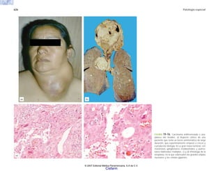 626 Patología especial
FIGURA 19-16. Carcinoma indiferenciado o ana-
plásico del tiroides. a) Aspecto clínico de una
paciente que tenía un bocio asintomático de larga
duración, que repentinamente empezó a crecer y
a producirle disfagia. b) La gran masa tumoral, con
metástasis ganglionares mediastinales y pulmo-
nares bilaterales múltiples. c) y d) Histología de la
neoplasia, en la que sobresalen las grandes atipias
nucleares y las células gigantes.
(a) (b)
(c)
(c)
© 2007 Editorial Médica Panamericana, S.A de C.V.
Cisfarm
 