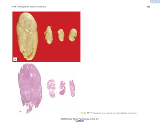 C19 Patología del sistema endocrino 627
FIGURA 19-17. Hiperplasia de una sola de las cuatro glándulas paratiroides.
(b)
(a)
© 2007 Editorial Médica Panamericana, S.A de C.V.
Cisfarm
 