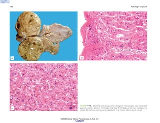 628 Patología especial
FIGURA 19-18. Adenoma cortical suprarrenal. a) Aspecto macroscópico, que muestra un
pequeño quiste y áreas de hemorragia focal. b) y c) Histología de las áreas subcapsular y
central del adenoma, que muestran variaciones en el tamaño y forma de las células.
(c)
(a) (b)
© 2007 Editorial Médica Panamericana, S.A de C.V.
Cisfarm
 