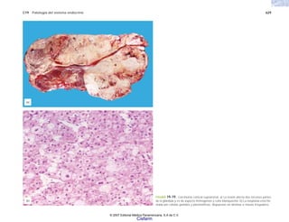 C19 Patología del sistema endocrino 629
FIGURA 19-19. Carcinoma cortical suprarrenal. a) La lesión afecta dos terceras partes
de la glándula y es de aspecto homogéneo y color blanquecino. b) La neoplasia está for-
mada por células grandes y pleomórficas, dispuestas en láminas o masas irregulares.
(b)
(a)
© 2007 Editorial Médica Panamericana, S.A de C.V.
Cisfarm
 