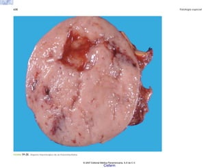 630 Patología especial
FIGURA 19-20. Aspecto macroscópico de un feocromocitoma.
© 2007 Editorial Médica Panamericana, S.A de C.V.
Cisfarm
 