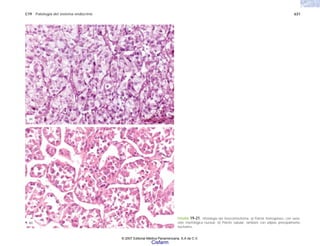 C19 Patología del sistema endocrino 631
FIGURA 19-21. Histología del feocromocitoma. a) Patrón homogéneo, con varia-
ción morfológica nuclear. b) Patrón tubular, también con atipias principalmente
nucleares.
(b)
(a)
© 2007 Editorial Médica Panamericana, S.A de C.V.
Cisfarm
 