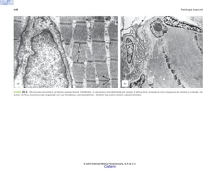 640 Patología especial
FIGURA 20-2. Microscopia electrónica. a) Núcleo subsarcolemal. Miofibrillas, la sarcómera está delimitada por bandas Z (alfa-actina); la banda A está compuesta de miosina y la banda I de
actina. b) Placa neuromuscular (izquierda) con sus hendiduras correspondientes. También hay varios núcleos subsarcolemales.
(b)
(a)
A
Z
I
© 2007 Editorial Médica Panamericana, S.A de C.V.
Cisfarm
 