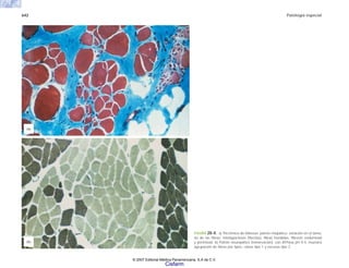 642 Patología especial
FIGURA 20-4. a) Tricrómico de Masson, patrón miopático: variación en el tama-
ño de las fibras; miofagocitosis (flechas); fibras hendidas, fibrosis endomisial
y perimisial. b) Patrón neuropático (reinervación): con ATPasa pH 9.4, muestra
agrupación de fibras por tipos, claras tipo 1 y oscuras tipo 2.
(b)
(a)
© 2007 Editorial Médica Panamericana, S.A de C.V.
Cisfarm
 