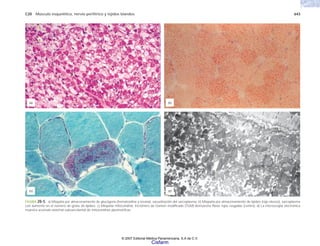 C20 Músculo esquelético, nervio periférico y tejidos blandos 643
FIGURA 20-5. a) Miopatía por almacenamiento de glucógeno (hematoxilina y eosina), vacuolización del sarcoplasma. b) Miopatía por almacenamiento de lípidos (rojo oleoso), sarcoplasma
con aumento en el número de gotas de lípidos. c) Miopatía mitocondrial, tricrómico de Gomori modificado (TGM) demuestra fibras rojas rasgadas (centro); d) La microscopia electrónica
muestra acúmulo anormal subsarcolemal de mitocondrias pleomórficas.
(a) (b)
(d)
(c)
© 2007 Editorial Médica Panamericana, S.A de C.V.
Cisfarm
 