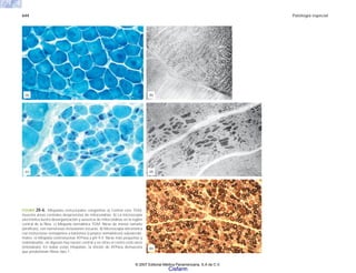 644 Patología especial
FIGURA 20-6. Miopatías estructurales congénitas a) Central core TGM:
muestra áreas centrales desprovistas de mitocondrias. b) La microscopia
electrónica ilustra desorganización y ausencia de mitocondrias en la región
central de la fibra. c) Miopatía nemalínica TGM: fibras de menor tamaño
(atróficas), con numerosas inclusiones oscuras. d) Microscopia electrónica
con estructuras semejantes a bastones (cuerpos nemalínicos) subsarcole-
males. e) Miopatía centronuclear ATPasa a pH 9.4: fibras más pequeñas y
redondeadas, en algunas hay núcleo central y en otras el centro está vacío
(miotúbulo). En todas estas miopatías, la tinción de ATPasa demuestra
que predominan fibras tipo 1.
(a) (b)
(c) (d)
(e)
© 2007 Editorial Médica Panamericana, S.A de C.V.
Cisfarm
 