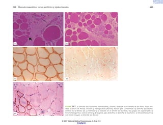 C20 Músculo esquelético, nervio periférico y tejidos blandos 645
FIGURA 20-7. a) Distrofia tipo Duchenne (Hematoxilina y Eosina). Variación en el tamaño de las fibras; fibras hen-
didas (cabezas de flecha), necrosis y miofagocitosis (flechas), fibrosis peri y endomisial. b) Distrofia tipo Becker,
además de la fibrosis epi y endomisial y la variación en el tamaño de las fibras, hay grupos de regeneración. c)
Inmunohistoquímica: control normal y d) Negativa, para distrofina en distrofia de Duchenne. e) Inmunohistoquímica
con tinción irregular en distrofia tipo Becker.
(c)
(a)
(d)
(e)
(b)
© 2007 Editorial Médica Panamericana, S.A de C.V.
Cisfarm
 