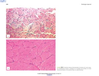 646 Patología especial
FIGURA 20-8. Distrofia mitónica (Hematoxilina y Eosina) a) El corte mues-
tra centralización nuclear y variación en el tamaño de las fibras. b) Corte
transversal donde se encuentran fibras en anillo (flechas).
(b)
(a)
© 2007 Editorial Médica Panamericana, S.A de C.V.
Cisfarm
 