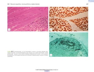 C20 Músculo esquelético, nervio periférico y tejidos blandos 647
FIGURA 20-9. Dermatomiositis. a) Con hematoxilina y eosina se encuentra infiltrado infla-
matorio linfocitario. b) Inmunohistoquímica para miosina con un patrón denominado “atrofia
perifascicular”, que por sí solo revela la naturaleza inflamatoria de la lesión. c) En ocasiones
acompañado en microscopia electrónica por inclusiones tubuloreticulares (centro) en células
endoteliales.
(a) (b)
(c)
© 2007 Editorial Médica Panamericana, S.A de C.V.
Cisfarm
 