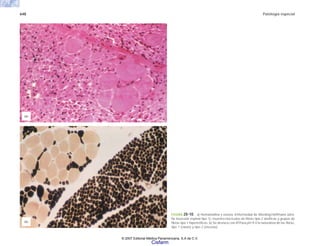 648 Patología especial
FIGURA 20-10. a) Hematoxilina y eosina. Enfermedad de Werdnig-Hoffmann (atro-
fia muscular espinal tipo 1), muestra fascículos de fibras tipo 2 atróficas y grupos de
fibras tipo 1 hipertróficas. b) Se destaca con ATPasa pH 9.4 la naturaleza de las fibras,
tipo 1 (claras) y tipo 2 (oscuras).
(a)
(b)
© 2007 Editorial Médica Panamericana, S.A de C.V.
Cisfarm
 