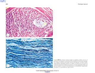 650 Patología especial
FIGURA 20-12. a) Nervio normal incluido en parafina y teñido con H-E. El
perineuro está dispuesto concéntricamente alrededor de fascículos individua-
les y separa el endoneuro del tejido conectivo del epineuro. Las fibras mielini-
zadas grandes individuales pueden ser visibles; se observa con frecuencia el
cuerpo de Renaud por debajo del perineuro. b) Corte longitudinal teñido con
azul de toluidina; se observa desmielinización y remielinización segmentaria;
la mielina se ve arrosariada de negro intenso.
(b)
(a)
© 2007 Editorial Médica Panamericana, S.A de C.V.
Cisfarm
 