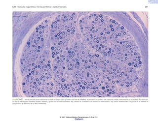 C20 Músculo esquelético, nervio periférico y tejidos blandos 651
FIGURA 20-13. Nervio normal corte transversal incluido en resina Epon y teñido con azul de toluidina; el perineuro es visible, son capas de células concéntricas en la periferia del fascículo;
las fibras mielinizadas exhiben tamaño variable y grosor de la mielina variable; hay células de Schwann con axones no mielinizados; hay vasos endoneurales, el grosor de la mielina es
proporcional al diámetro de la fibra mielinizada.
© 2007 Editorial Médica Panamericana, S.A de C.V.
Cisfarm
 