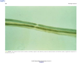 652 Patología especial
FIGURA 20-14. Fibra aislada de nervio normal; la mielina es osmiofílica, regular en color, diámetro y silueta; los nodos de Ranvier son fácilmente visibles y regularmente dispuestos en
intervalos de casi 1 mm.
© 2007 Editorial Médica Panamericana, S.A de C.V.
Cisfarm
 