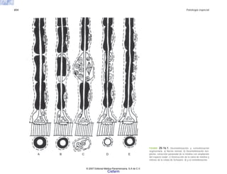 654 Patología especial
A B C D E
FIGURA 20-16.1. Desmielinización y remielinización
segmentaria. a) Nervio normal. b) Desmielinización inci-
piente, retracción paranodal de la mielina con ampliación
del espacio nodal. c) Destrucción de la vaina de mielina y
mitosis de la célula de Schwann. d) y e) remielinización.
© 2007 Editorial Médica Panamericana, S.A de C.V.
Cisfarm
 