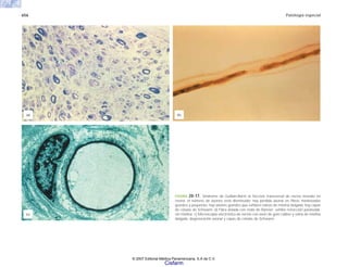 656 Patología especial
FIGURA 20-17. Síndrome de Guillain-Barré a) Sección transversal de nervio incluido en
resina; el número de axones está disminuido; hay pérdida axonal en fibras mielinizadas
grandes y pequeñas; hay axones grandes que exhiben vainas de mielina delgada; hay capas
de células de Schwann. b) Fibra aislada con nodo de Ranvier; exhibe retracción paranodal,
sin mielina. c) Microscopía electrónica de nervio con axón de gran calibre y vaina de mielina
delgada, degeneración axonal y capas de células de Schwann.
(a) (b)
(c)
© 2007 Editorial Médica Panamericana, S.A de C.V.
Cisfarm
 